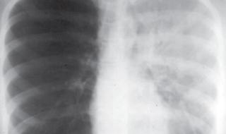 肺腺癌的早期症状 白肺的早期症状有哪些